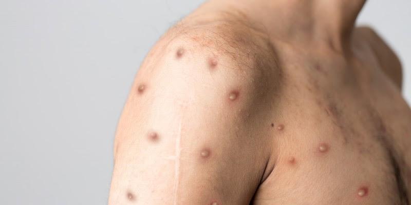 Saúde se mobiliza após 709 casos e 16 óbitos por mpox no Brasil em 2024